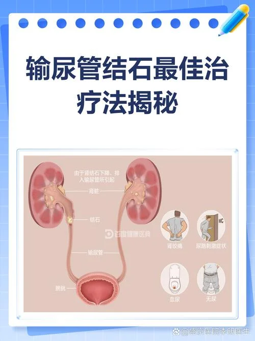 尿结石要怎么办-尿结石怎么办