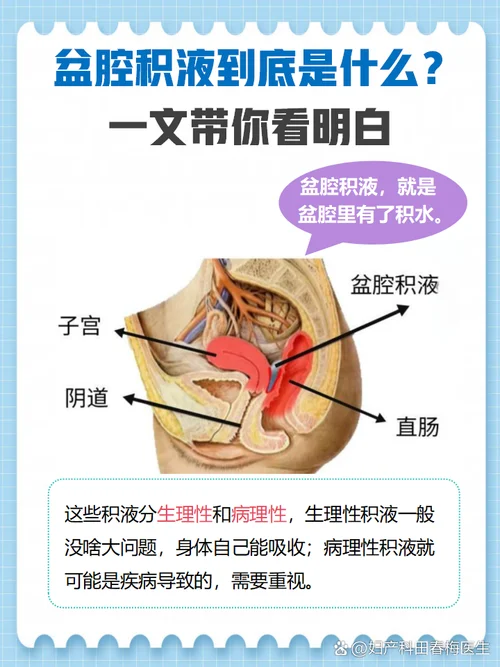 盆腔积液如何查-盆腔积液需检查