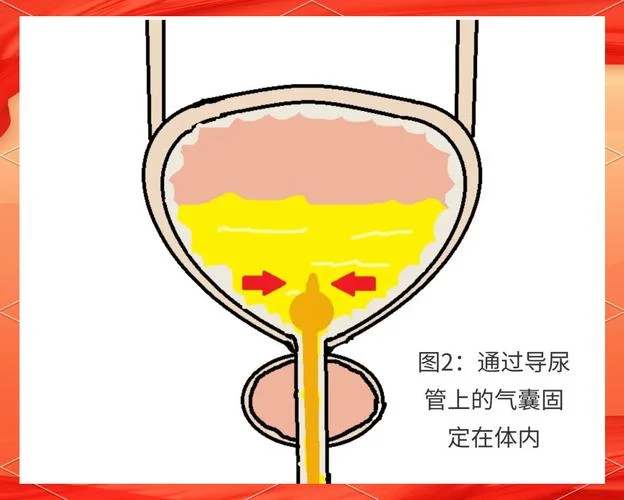 导尿管导尿原理_1