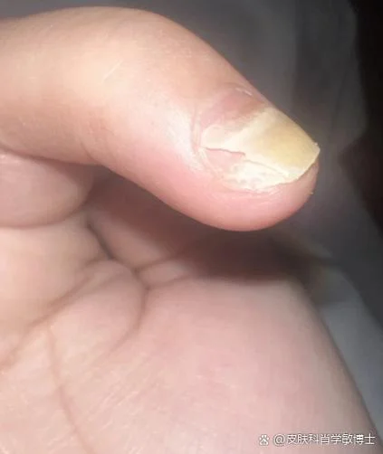指甲盖和肉分离叫什么_2