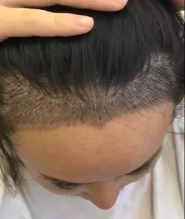 美人尖种植原理_2
