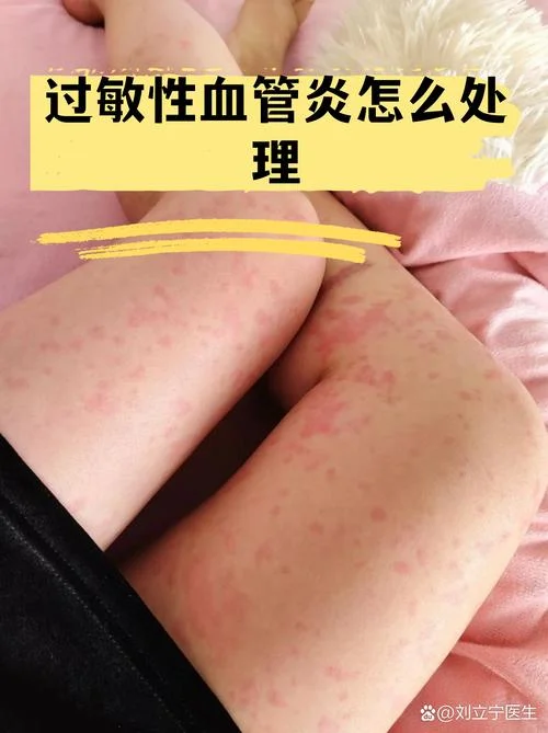 什么是血管炎病因_1