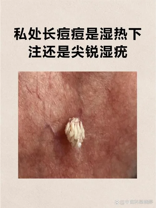 下体上长痘痘是为什么_2