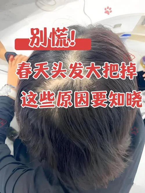 梦见自己掉头发一抓一大把-梦中脱发一抓一大把