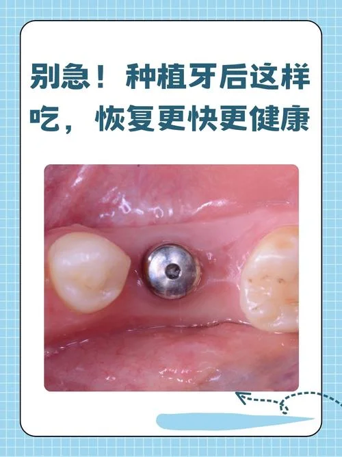 什么是全口种植牙修复_1