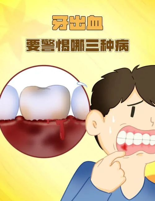 牙龈大量出血是为什么_1