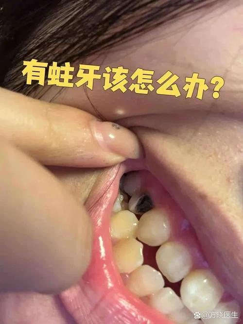 梦见自己牙齿蛀牙-梦见牙齿蛀虫