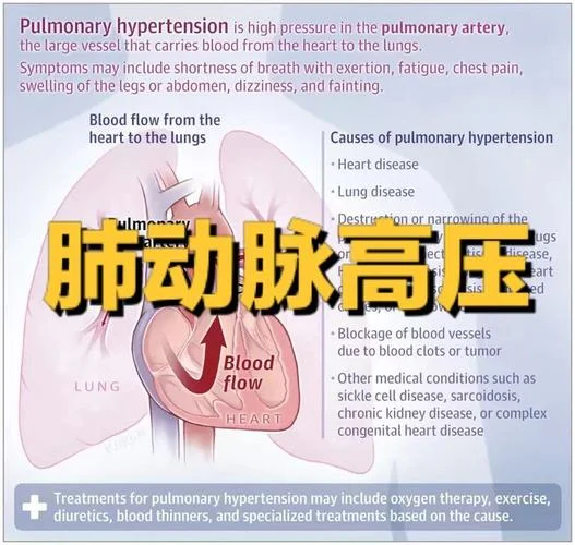 肺动脉高压什么意思_2