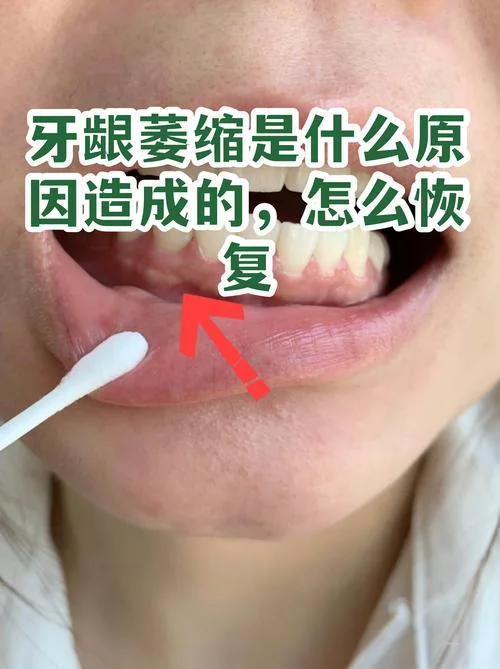 牙龈萎缩叫什么_1