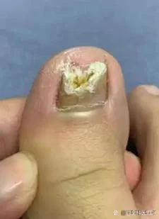 梦见脚大拇指烂了-梦足趾溃烂