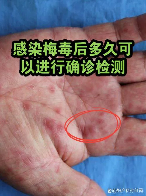 梅毒如何查的出来_2