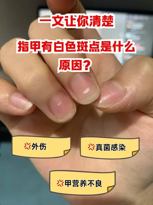 指甲发白是有什么病吗_2