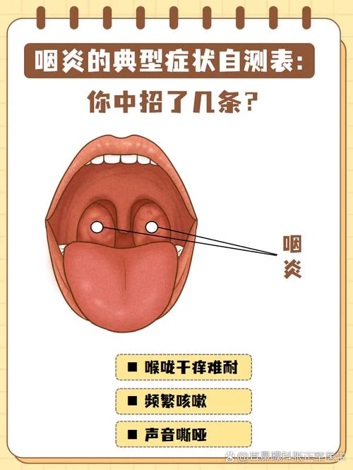 什么是病毒性咽炎_1