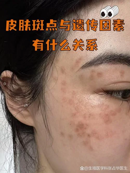 什么是真皮斑_1