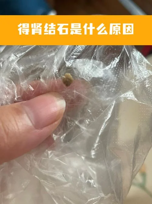 什么是肾结石_1