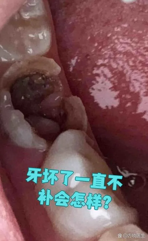 坏的牙齿叫什么_2