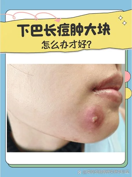 考研期间长痘痘怎么办-考研爆痘急救指南