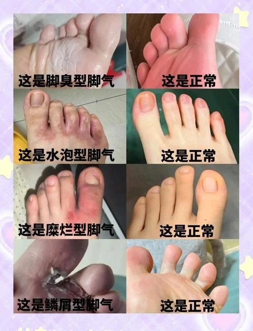 2岁宝宝有脚气怎么办-宝宝脚气紧急处理