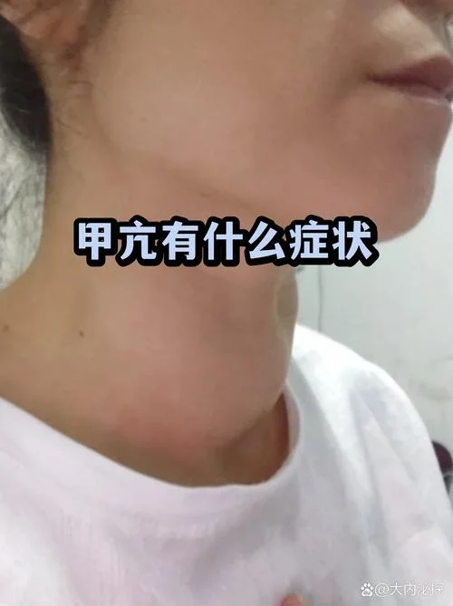 甲亢中医叫什么症状_1