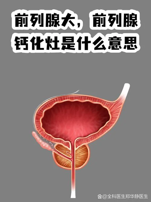 什么是前例腺钙化_1
