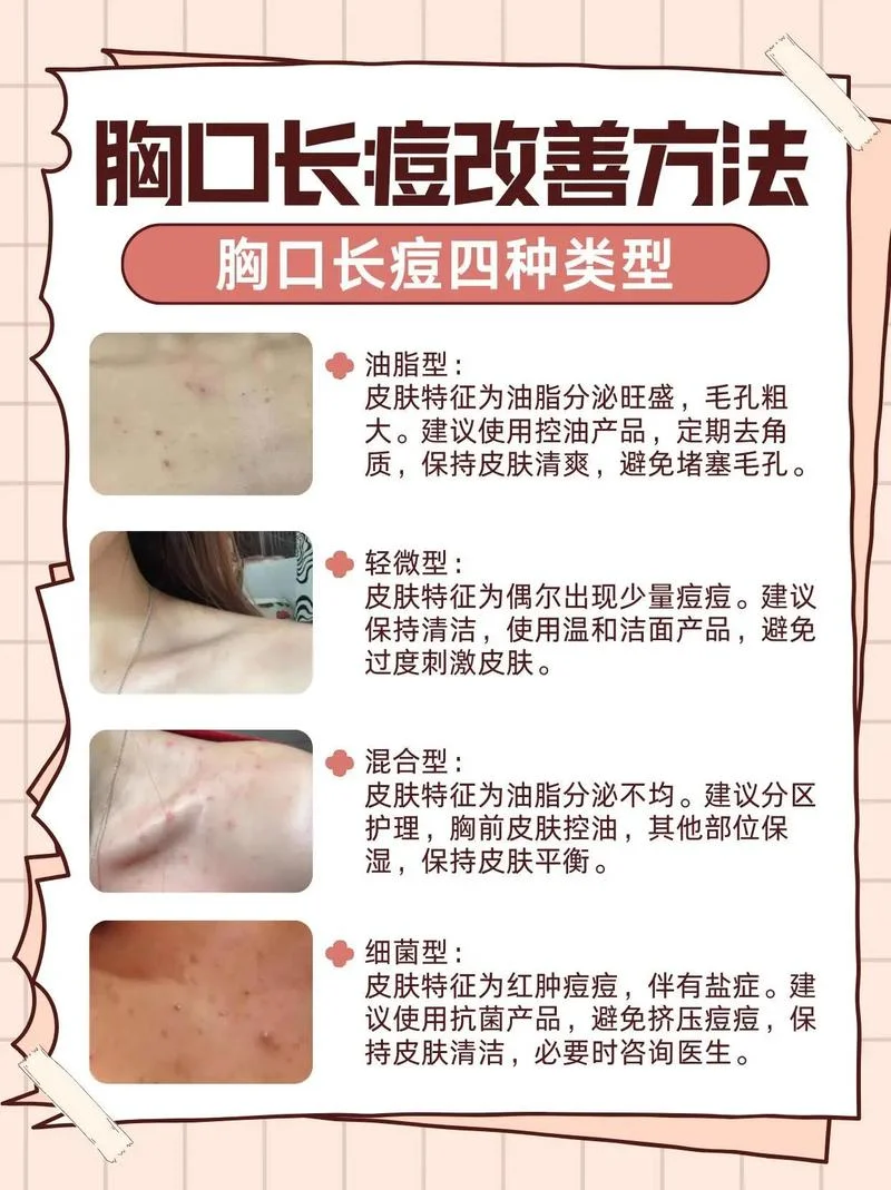 长痘痘了 怎么办-长痘痘怎么办