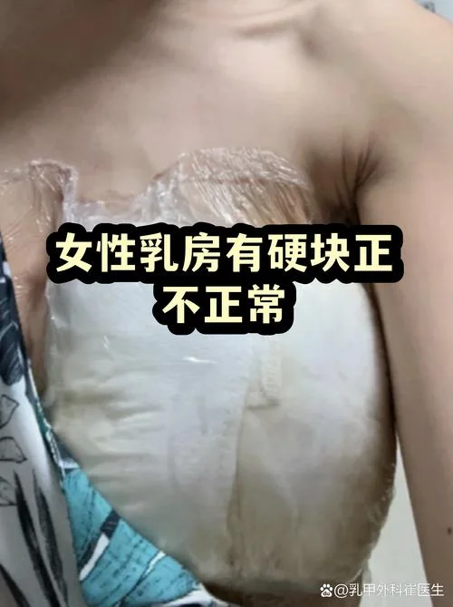 产妇副乳有硬块怎么办-产妇副乳硬块处理