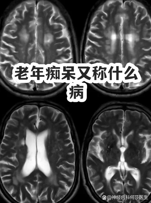 老年痴呆又名叫什么_2