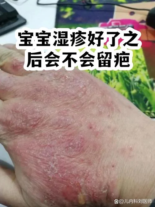 婴儿湿疹全身都是怎么办_2