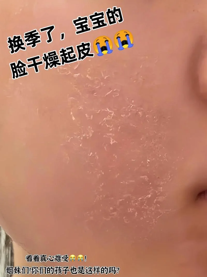脸反复过敏脱皮怎么办-脸反复过敏脱皮怎么办