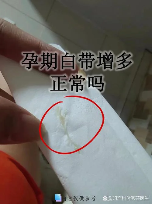 什么是白带异常吗_1