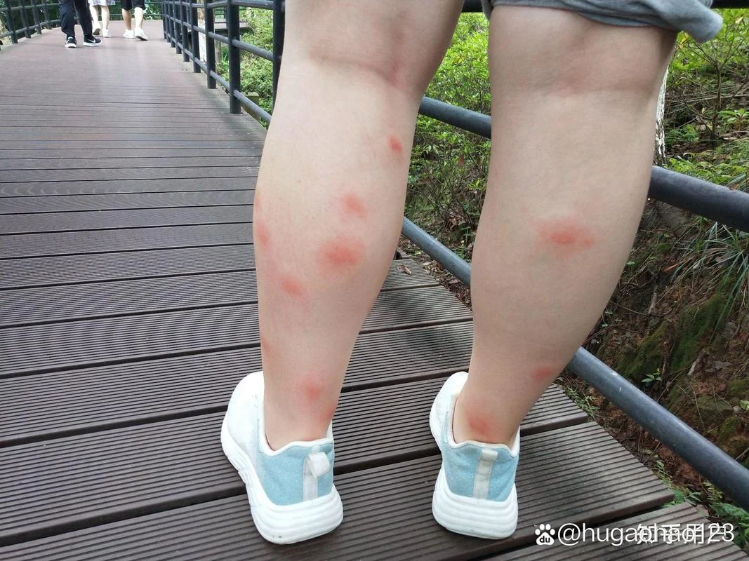 梦见被好多蚊子咬_2