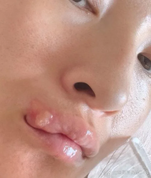 梦见自己下巴长水泡_1