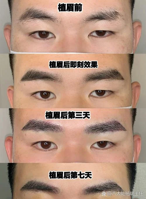 眉毛种植原理及方法_1