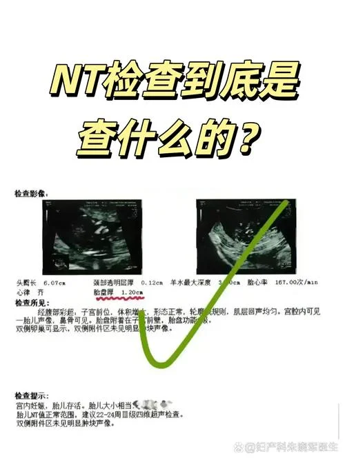 怀孕12周做nt是检查什么的_2