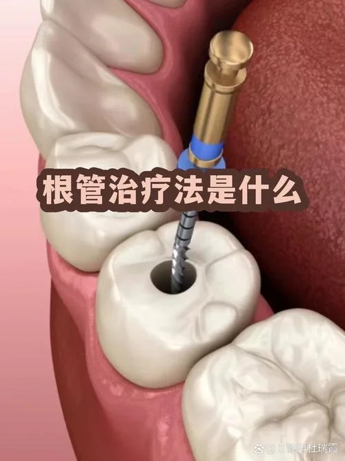 什么是做根管治疗_1