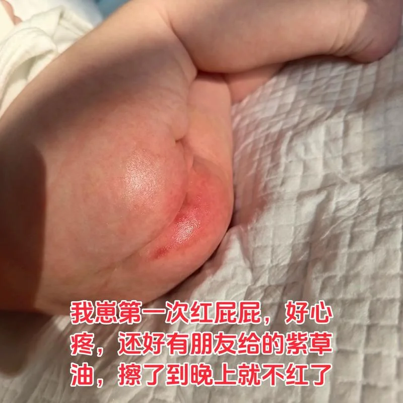宝宝屁屁红了破了怎么办_2