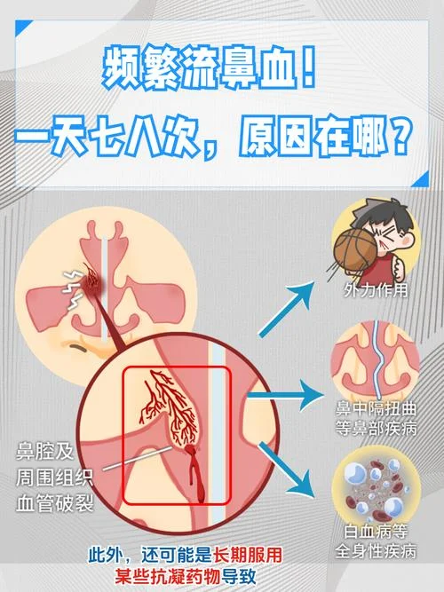 梦见出鼻血什么意思-梦见出鼻血含义解析