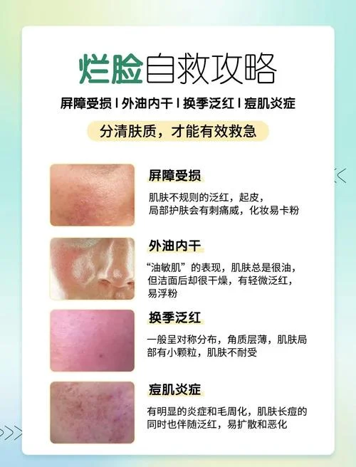 脸部干燥起痘痘怎么办-脸部干燥起痘痘怎么办