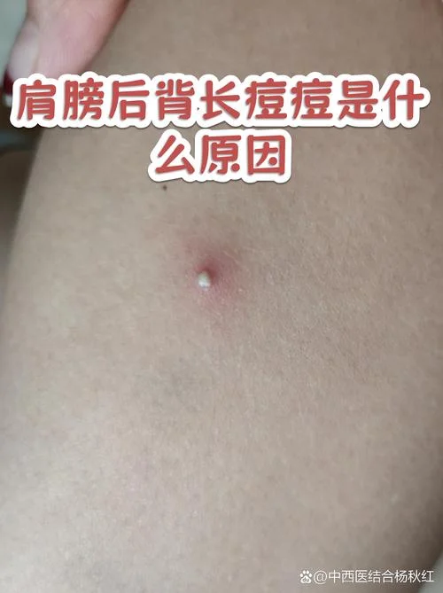 后背长痘痘了是为什么_1