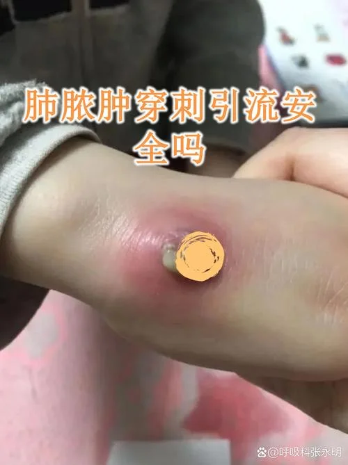 鼻子里面长脓包怎么办-鼻脓包如何处理