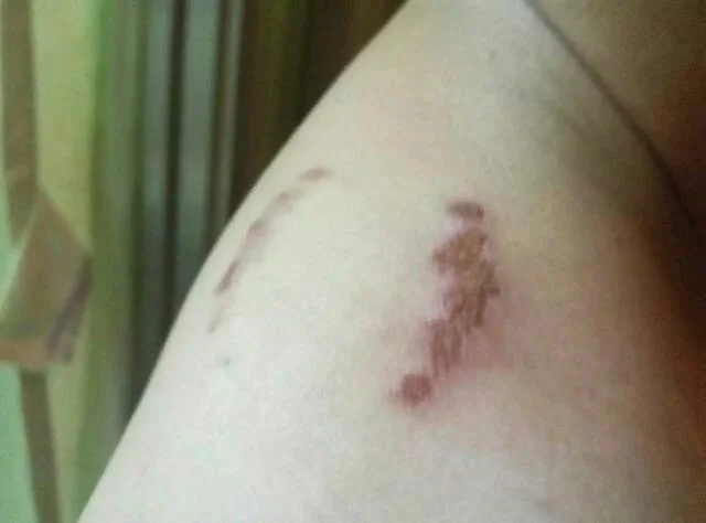 金子被咬出牙印怎么办-咬金牙印，无痕