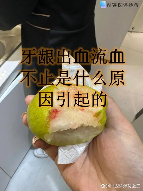 刷牙老是出血是为什么_1