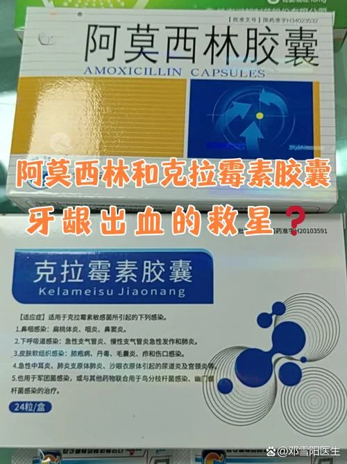 牙龈发炎买什么消炎药-牙龈发炎选消炎药