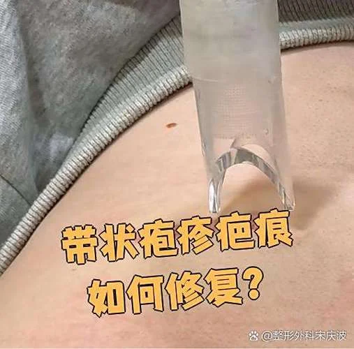 疱疹好了留疤了怎么办-疱疹留疤怎么办