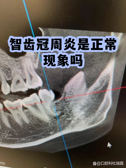 智齿项目口腔颌面部软组织损伤_1