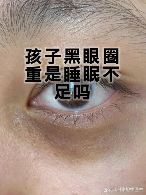 从算命上说有黑眼圈是-黑眼圈算作命相