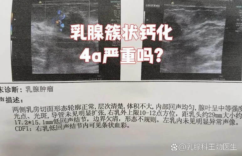 乳腺囊肿钙化是什么意思_1