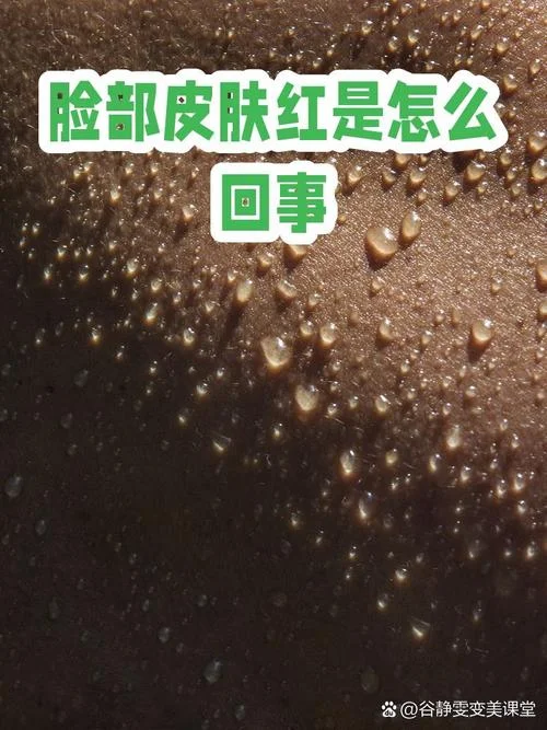 什么是敏感肌痘痘肌_1