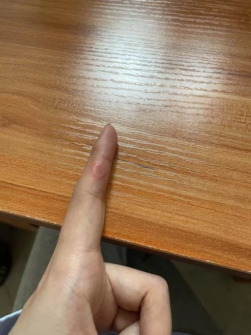 什么是肉芽肿图片大全_2