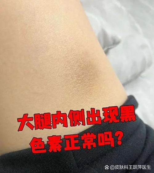 两大腿内侧很黑是为什么_1